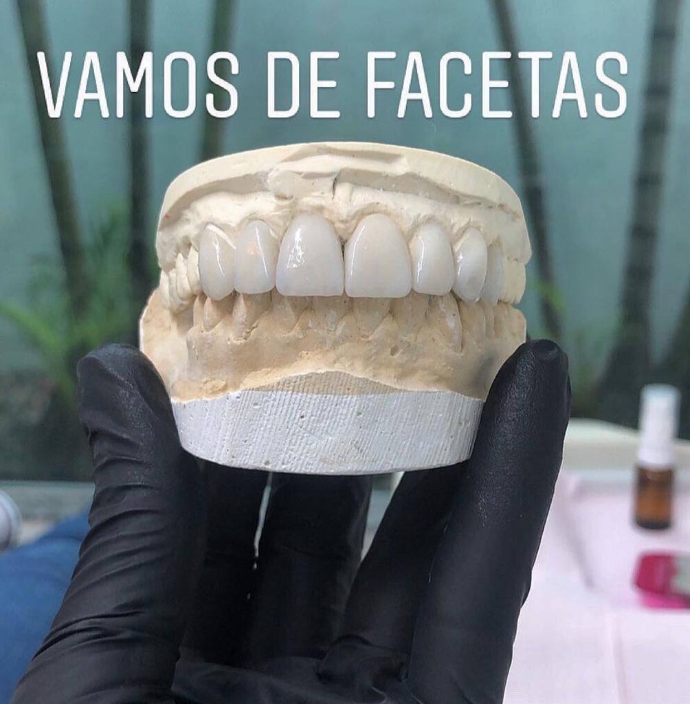 Confecção de facetas em laboratório